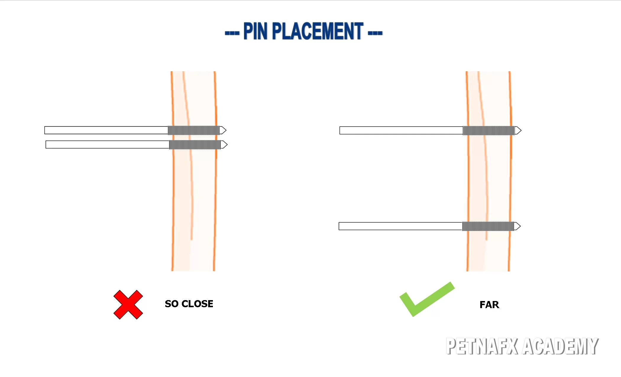 external fixator pin placement