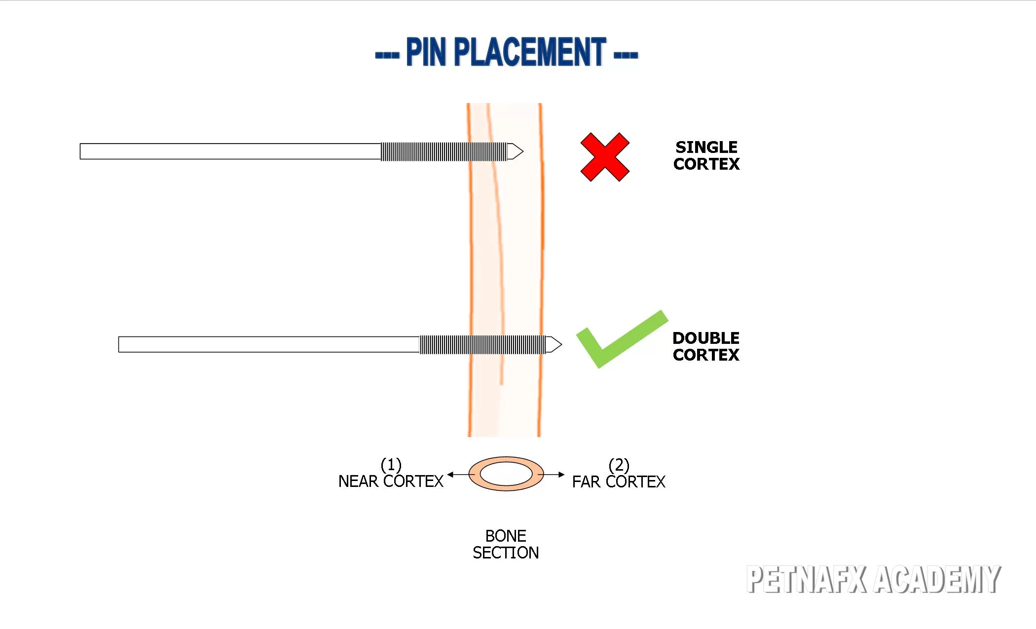 external fixator pin placement