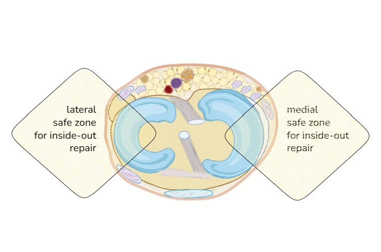 Safe Zones for Meniscal Repair
