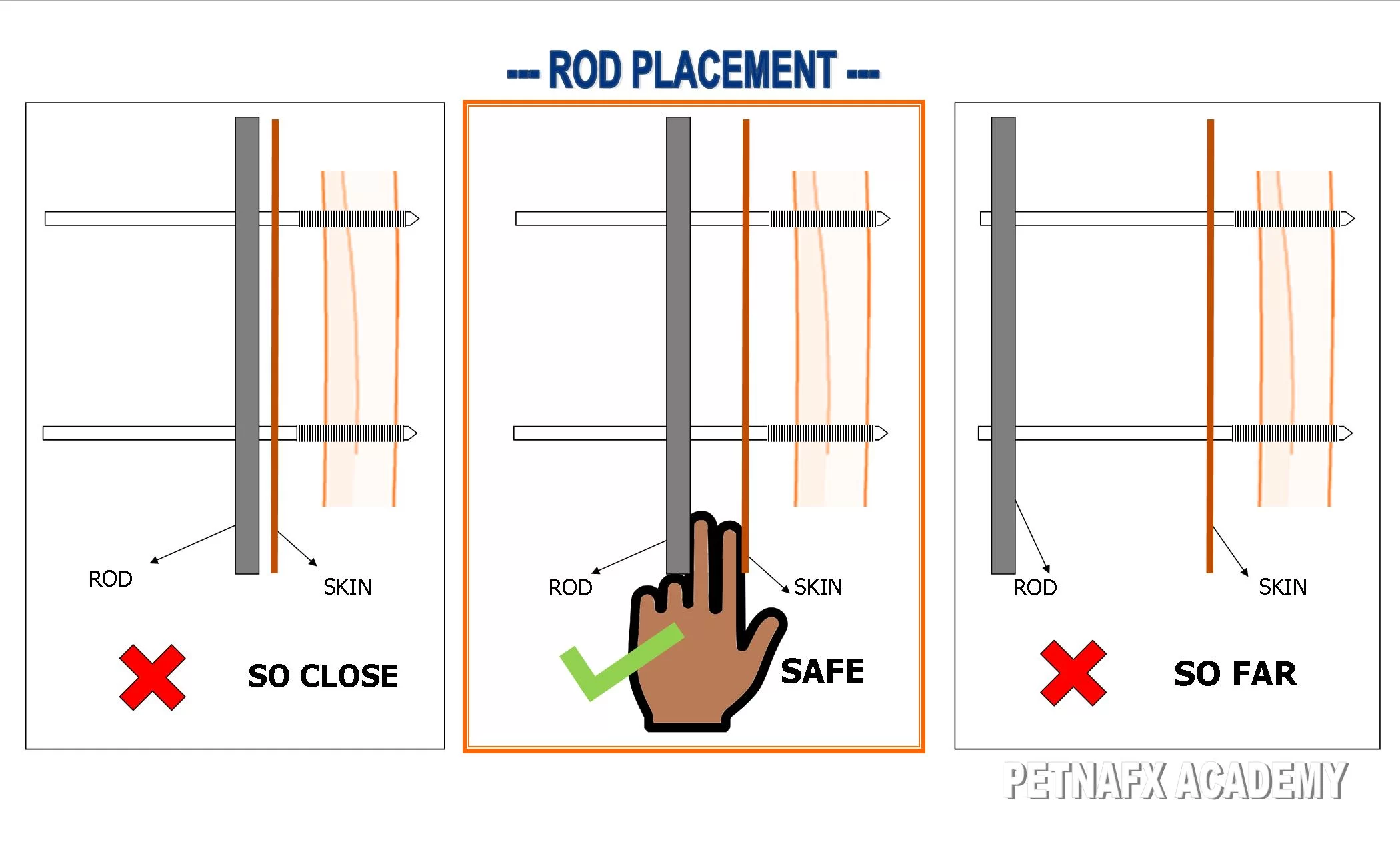 external fixator rod placement