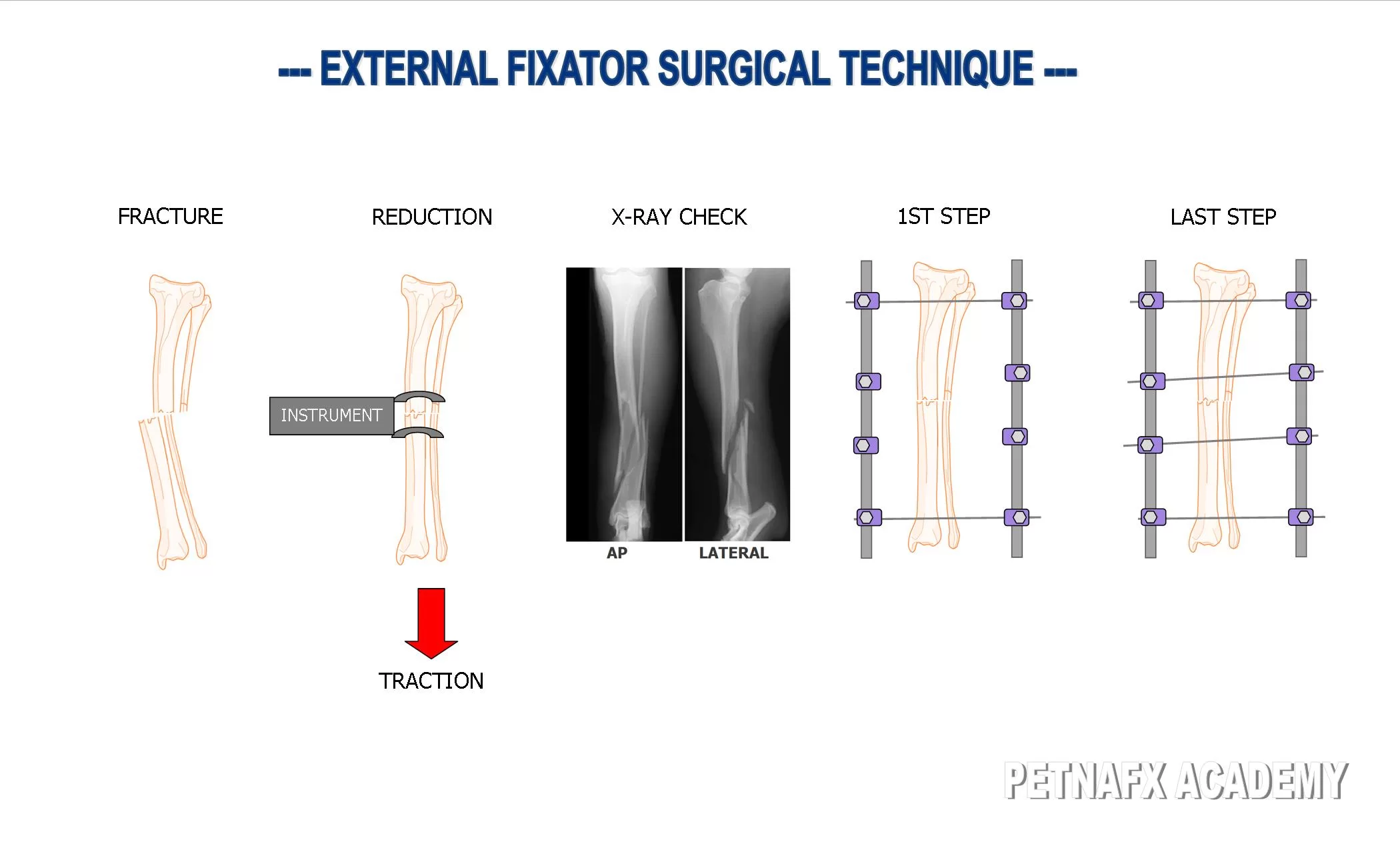 external fixator surgical technique