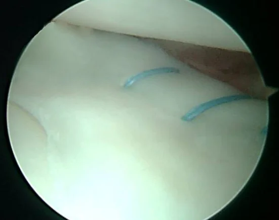 Meniscal Repair