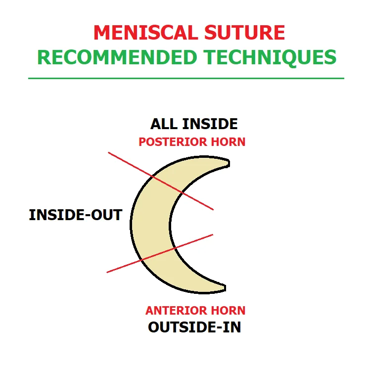 Meniscal Suture Technique