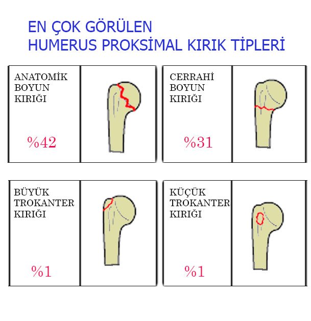 Humerus Proksimal Hibrid Fiksatör