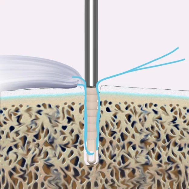 Knotless Suture Anchor System