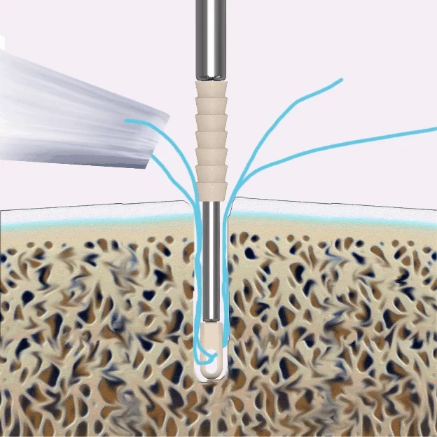 Knotless Suture Anchor System