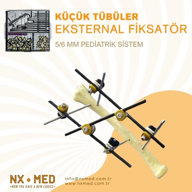 Küçük Tübüler Eksternal Fiksatör 