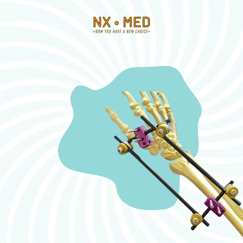 Küçük Tübüler Eksternal Fiksatör 