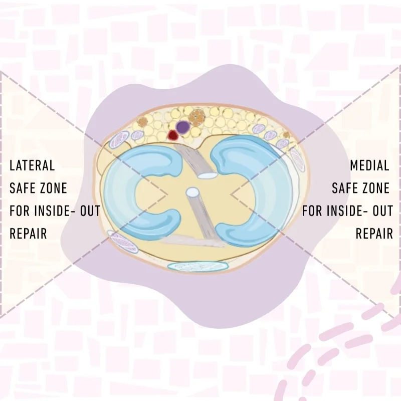 Meniscal Repair Suture Kit