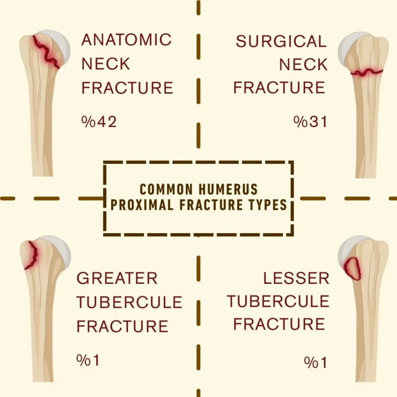 Humerus Proximal Hybrid Fixator