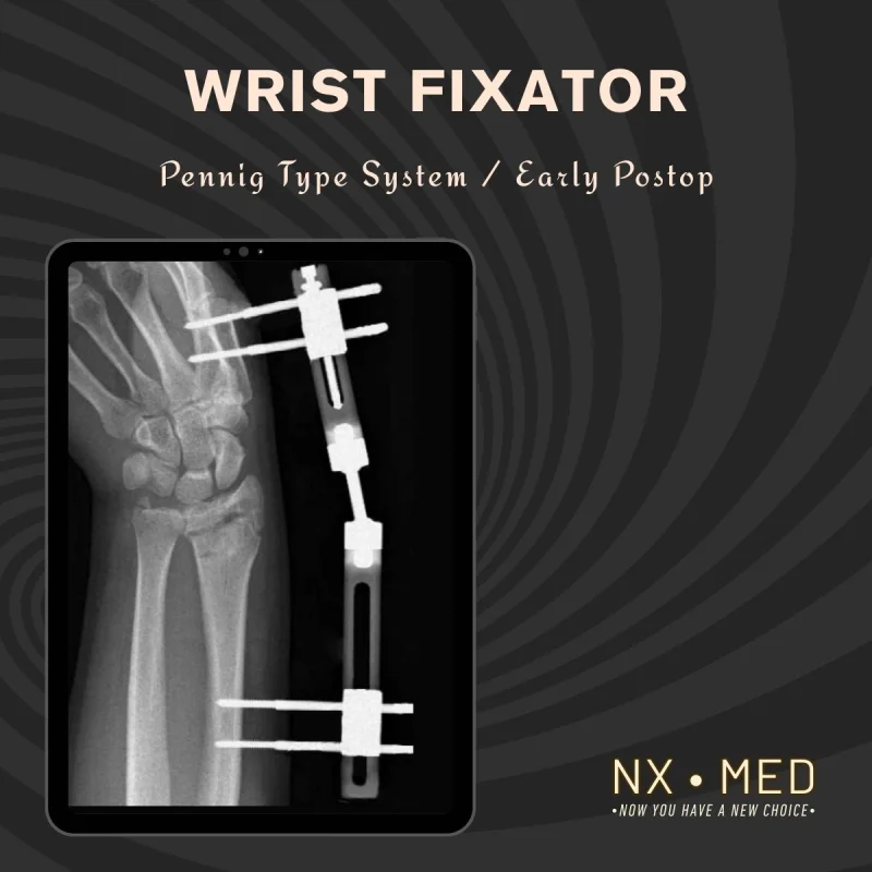 PENEF - Pennig Type Wrist Fixator
