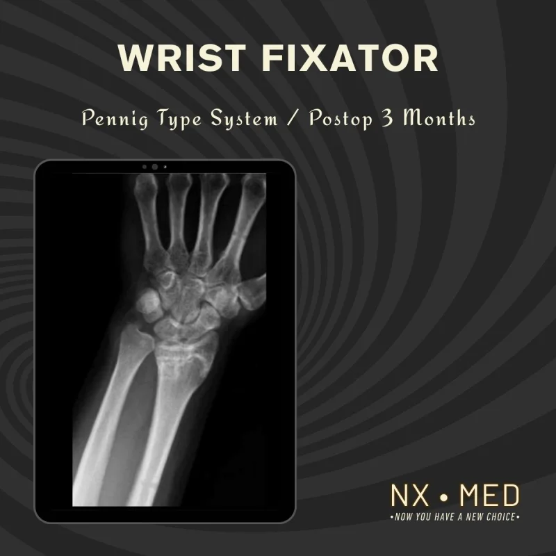 PENEF - Pennig Type Wrist Fixator