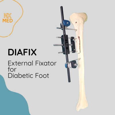 DIAFIX – Transverse Tibial Transport Fixator for Diabetic Foot