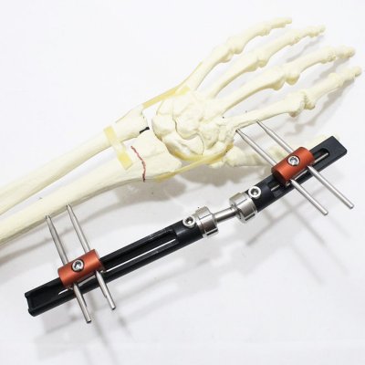 PENEF - Pennig Type Wrist Fixator