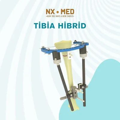 Tibia Hibrid Fiksatör