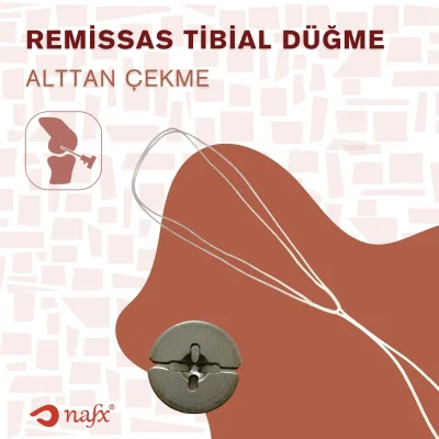 Tibial Düğme