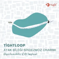 Ayak Bileği Çift Düğme İmplantı