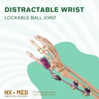 Distractable Wrist Fixator