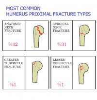 Humerus Proximal Hybrid Fixator