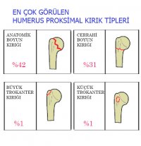 Humerus Proksimal Hibrid Fiksatör
