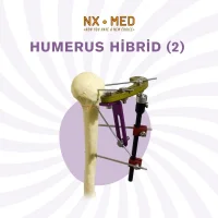 Humerus Proksimal Hibrid Fiksatör