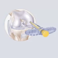 Mosaicplasty Set