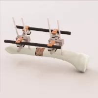 Büyük Tübüler Fiksatör