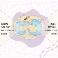 Meniscal Repair Suture Kit