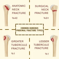 Humerus Proximal Hybrid Fixator
