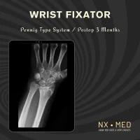 PENEF - Pennig Type Wrist Fixator